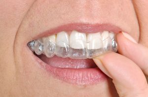 woman putting in aligner