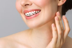 woman with metal braces